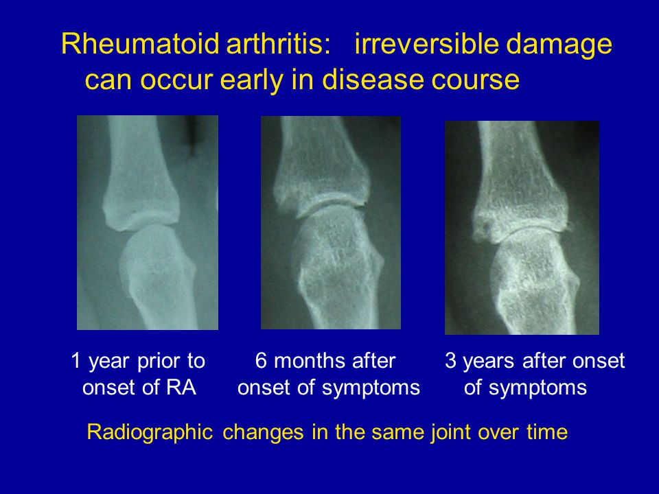 rheumatoid arthritis radiology ppt